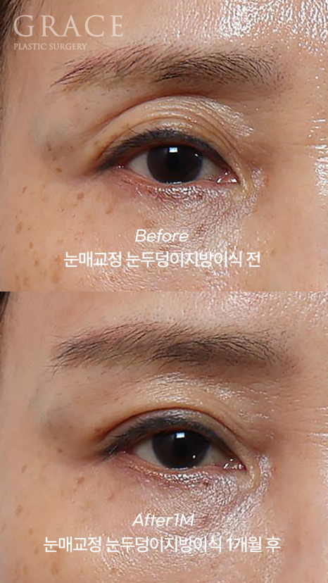 Is Upper Blepharoplasty Necessary at 58? Swelling Side Effects After Non-Incisional Ptosis Correction and Upper Eyelid Fat Grafting image 3