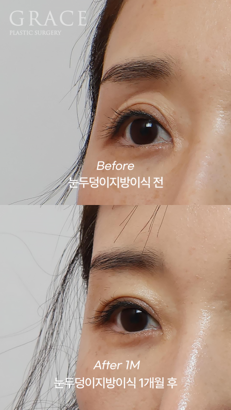 Eyelid Fat Grafting Side Effects? How to Settle In Beautifully Without Lumps image 10