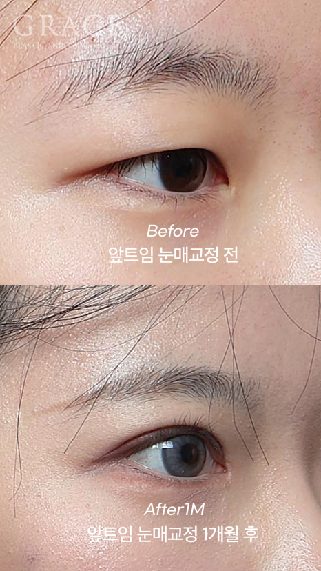 개강 후 난리 났다! 20살 눈매교정 앞트임 전후 관련 이미지 2