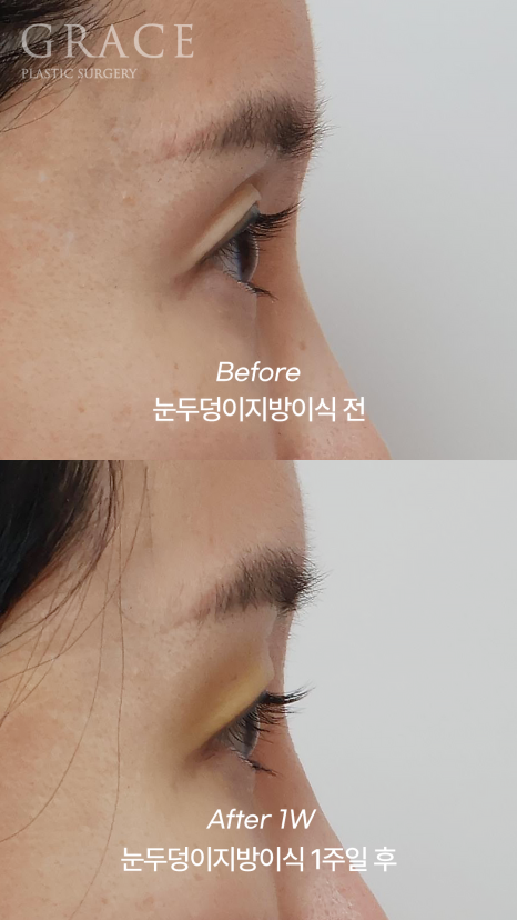 One-Week Changes After Eyelid Fat Grafting: Sunken Eye Hollows Regain Volume image 10