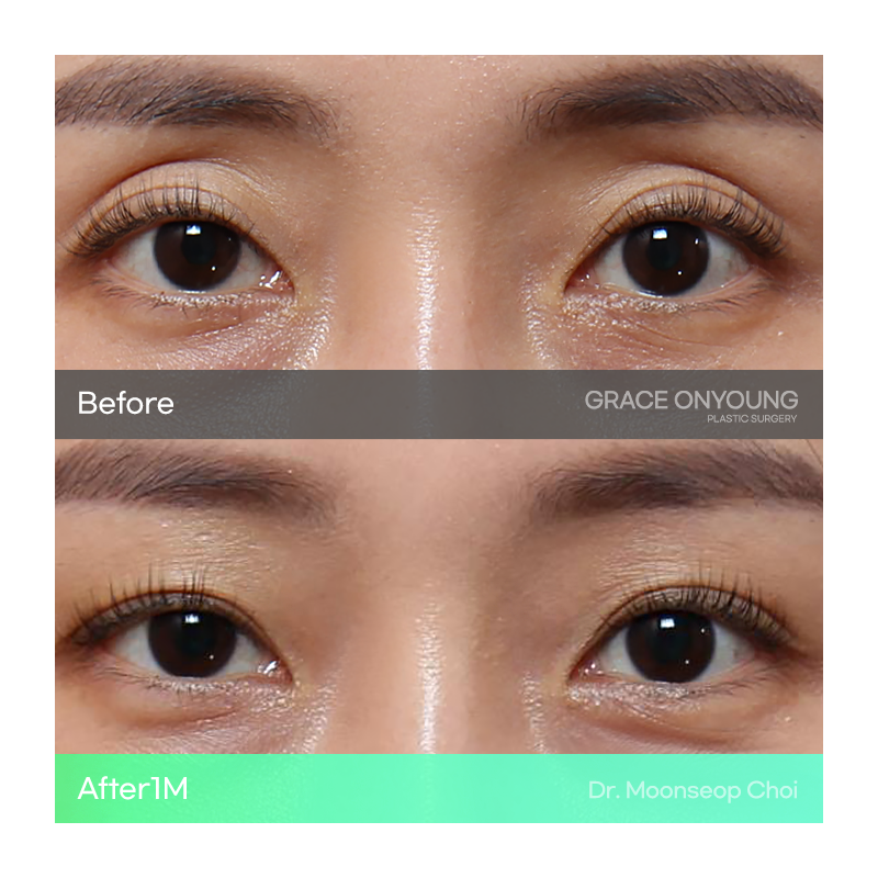Shocked After Hearing That My Hollow Eyes and Sunken Eye Holes Were Severe? Upper Eyelid Fat Grafting image 2