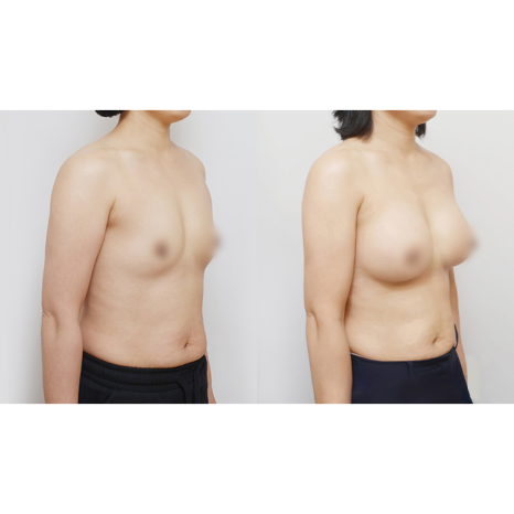Is Getting 360cc Motiva Implants All It Takes? The Real Difference Is Vertical Rearrangement image 3