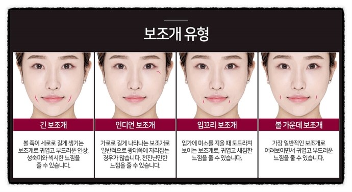 보조개수술후기 보고 심쿵한 매력♡ 관련 이미지 3