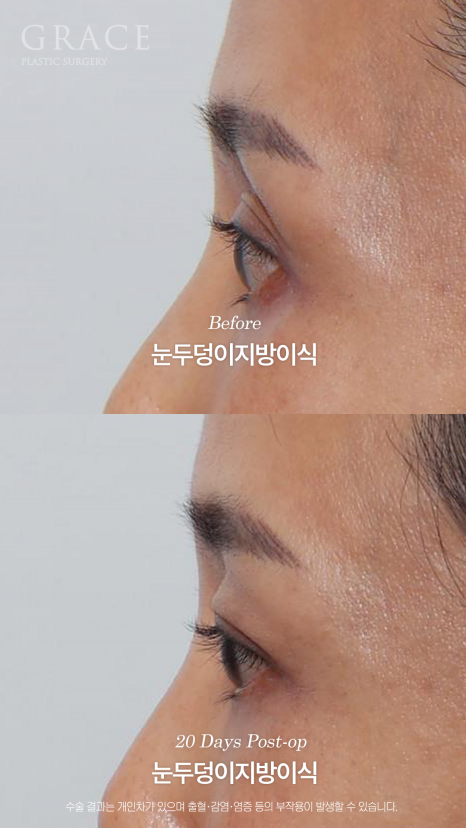 눈두덩이 지방이식 같은 내 지방인데 왜 울퉁불퉁해질까? 지방의 크기부터 다르니깐 관련 이미지 9