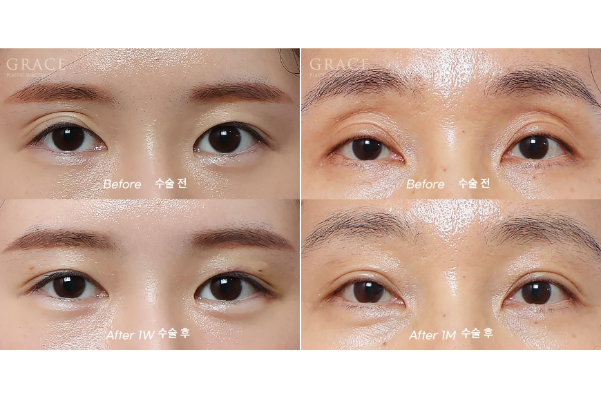 눈꺼풀 지방이식 후기처럼 자연스럽게 붓기&middot;흉터&middot;부작용 총정리 관련 이미지 6