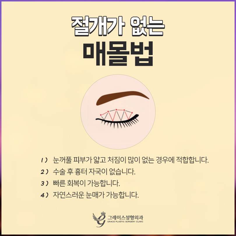 쌍수종류 자연유착?절개? 그레이스가 알려드려요 관련 이미지 4