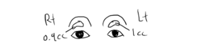 Sunken Eyelid Fat Grafting: Swelling After 1 Week Before & After image 1