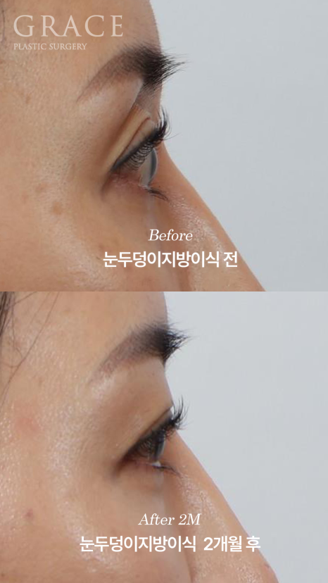 Is a Second Eyelid Fat Grafting Necessary? Are Frozen Fat Grafts a Side Effect? image 5