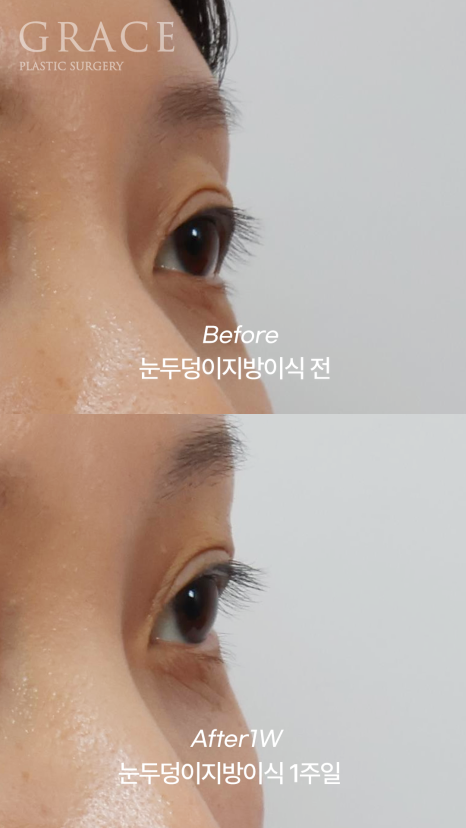 Fat Removal After Double Eyelid Surgery? Eyelid Fat Grafting After Double Eyelid Surgery Before & After image 3