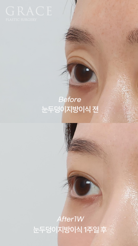 눈꺼풀 지방이식 잘하는 병원 그레이스성형외과 관련 이미지 8