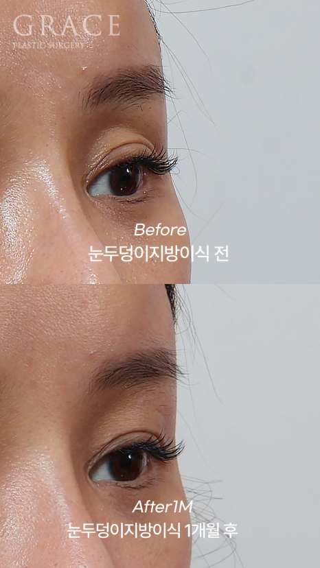 Why Injecting Fat Into the “Orbital Fat” Is Important in Sunken Eye Fat Grafting (dr.essay) image 3