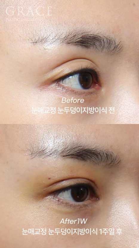 눈꺼풀지방이식+눈매교정 1주일 차 붓기&middot;노란 멍 그 후 3개월 관련 이미지 4