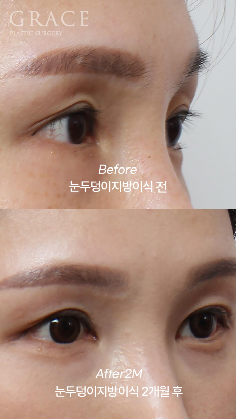 눈두덩이 지방이식 후 광명찾다?... 관련 이미지 2
