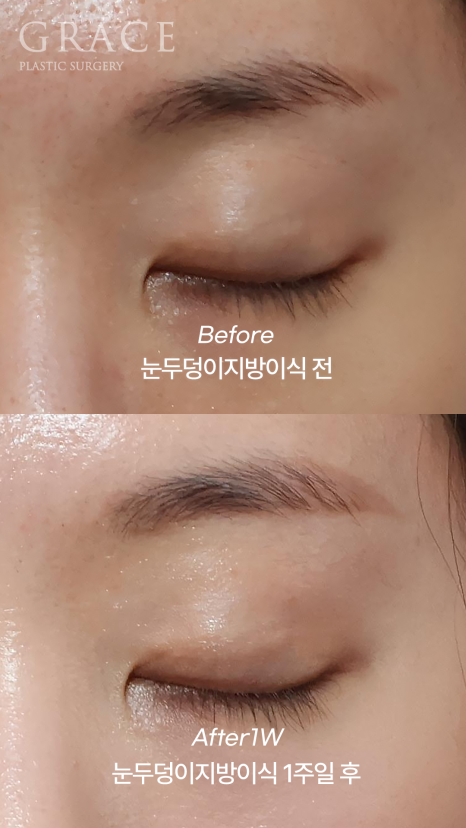 눈꺼풀 지방이식 잘하는 병원 그레이스성형외과 관련 이미지 1