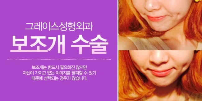 예쁜 미소 칭찬해, 그레이스성형외과 보조개 수술 관련 이미지 3