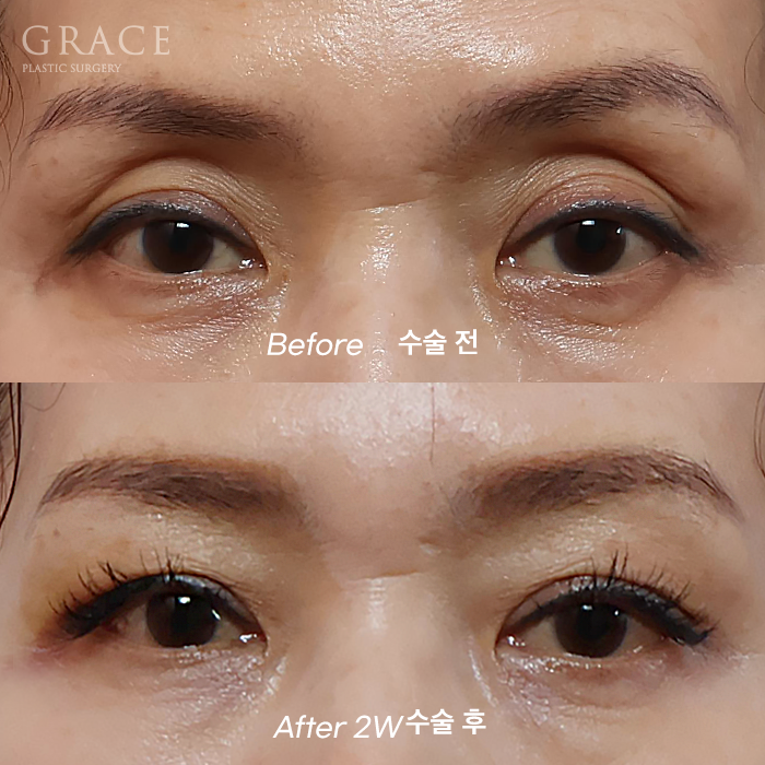 Concerns About Swelling and Side Effects After “Eye Hollow Fat Grafting” Surgery in the Eye Socket Area for People in Their 60s image 1