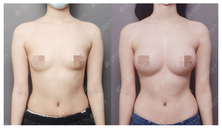How Should You Choose a Good Breast Augmentation Clinic? image 4
