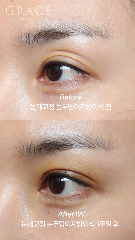 눈꺼풀지방이식+눈매교정 1주일 차 붓기&middot;노란 멍 그 후 3개월 관련 이미지 6