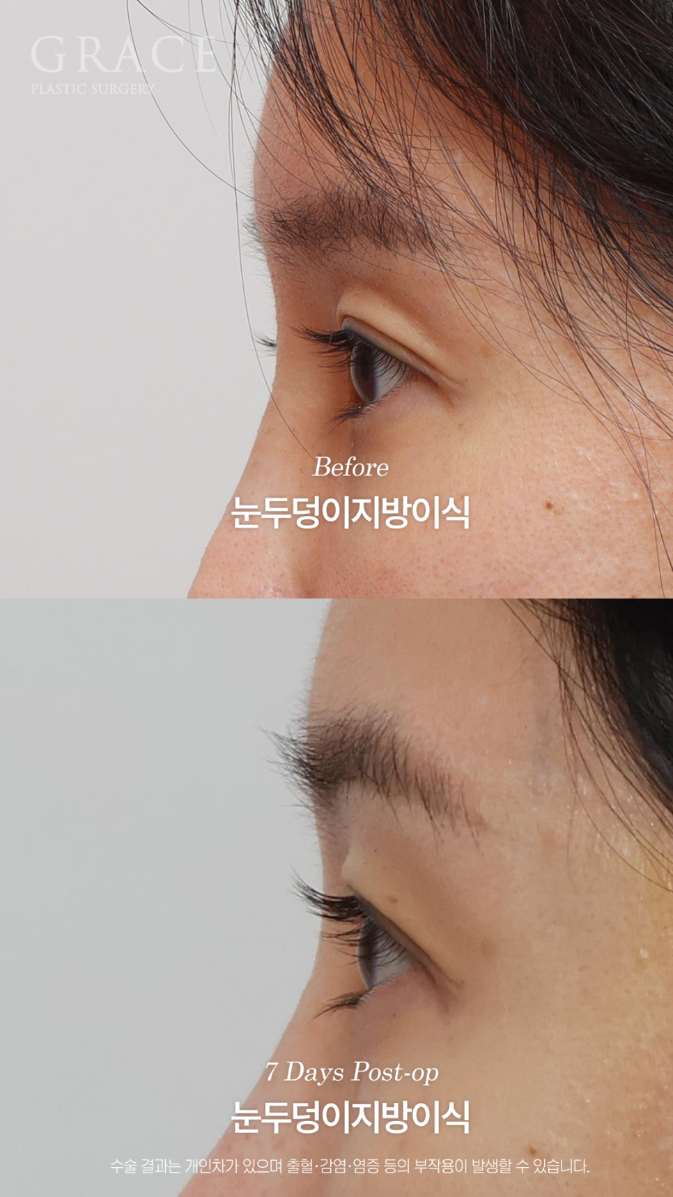 눈두덩이지방이식 하고 일주일 출근 가능한 정도일까? 관련 이미지 9