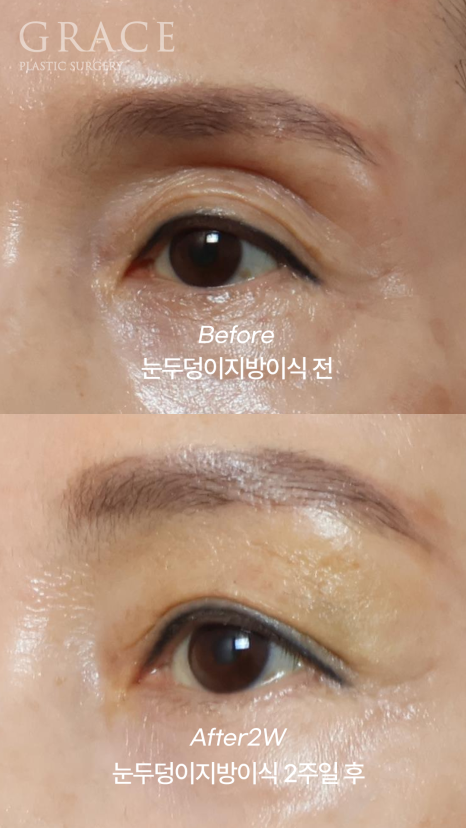 60대 중년 눈두덩이 안와지방이식 1cc 전후 관련 이미지 5