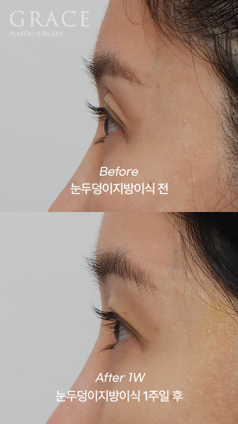 One-Week Changes After Eyelid Fat Grafting: Sunken Eye Hollows Regain Volume image 5