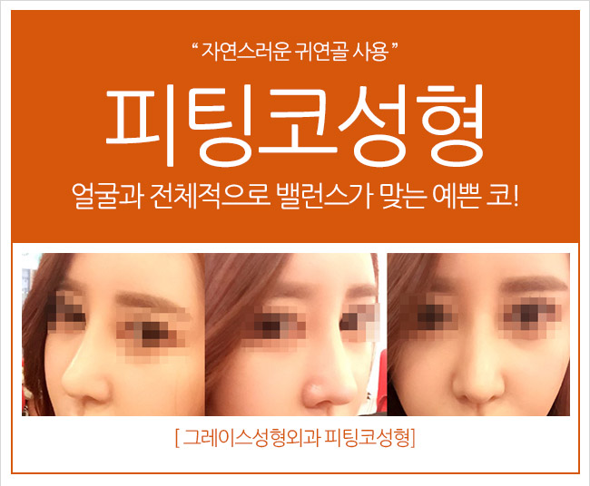 코성형 by 그레이스성형외과 피팅코 관련 이미지 3
