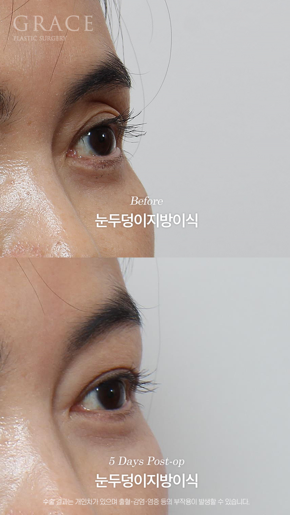 Will a Sunken Upper Eyelid Become Bumpy When You Close Your Eyes After Fat Grafting? image 6