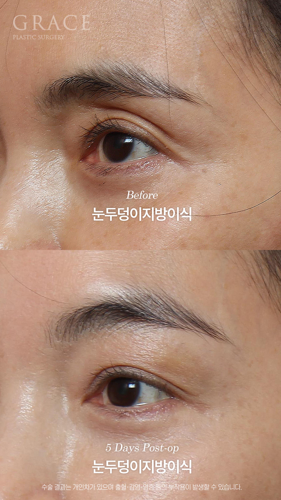 Will a Sunken Upper Eyelid Become Bumpy When You Close Your Eyes After Fat Grafting? image 2