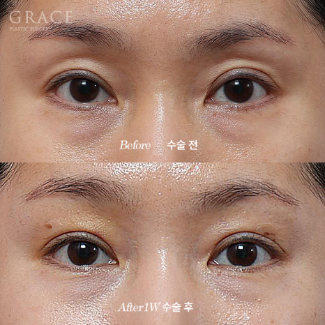 Why Choose Upper Eyelid Fat Grafting Instead of Eye-Hollow Filler? image 1