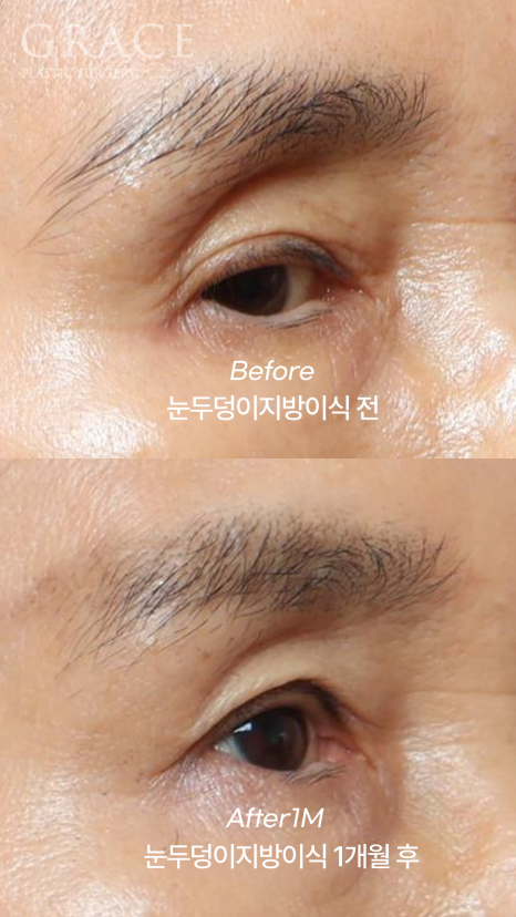 Will eyelid fat grafting be finished in one session? Progress after the first graft for a customer in their 60s and the planned second graft image 4