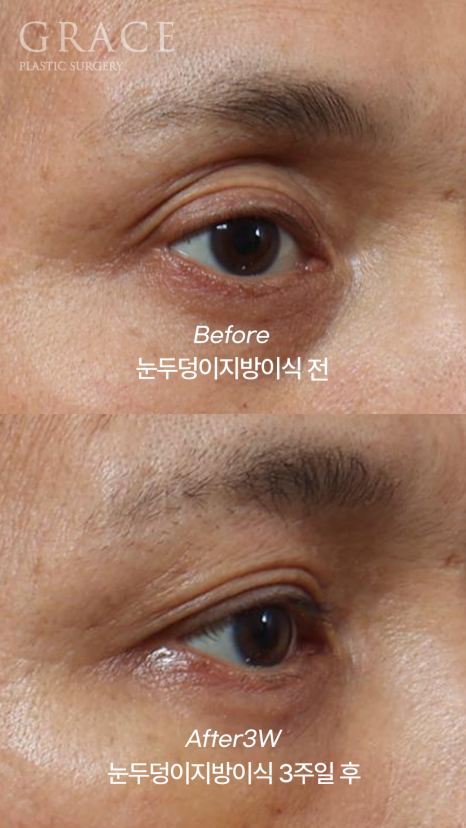 When the Eye Hollows Sink In, You Look Tired: Swelling After Fat Grafting for Men’s Eyes image 6