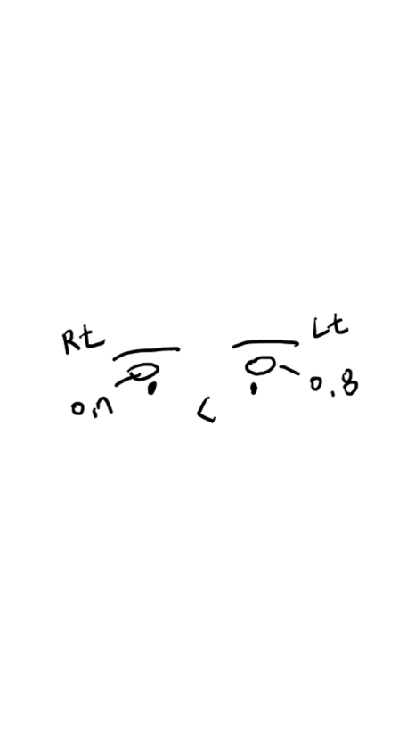 겹쌍꺼풀&middot;비대칭 눈 교정｜패인눈 함몰은 눈꺼풀 지방이식 관련 이미지 2