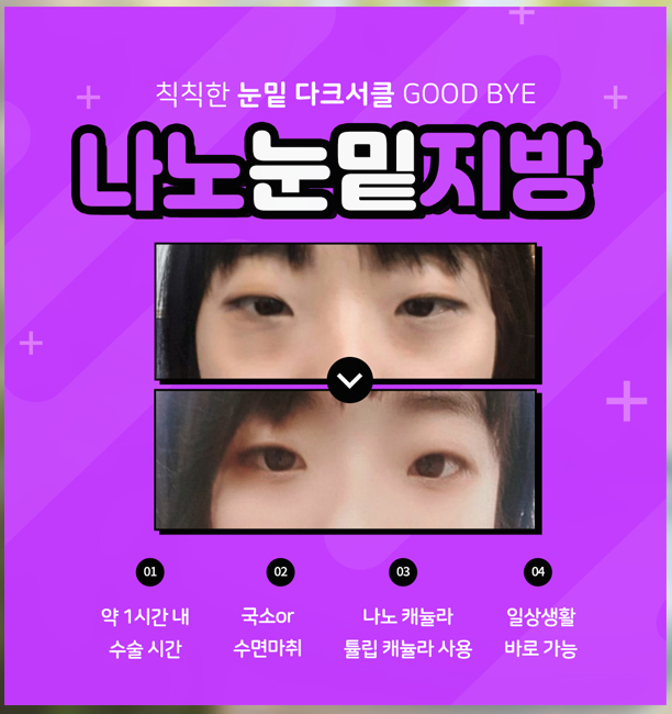 다크써클수술가격 눈밑이 밝아져요 관련 이미지 6