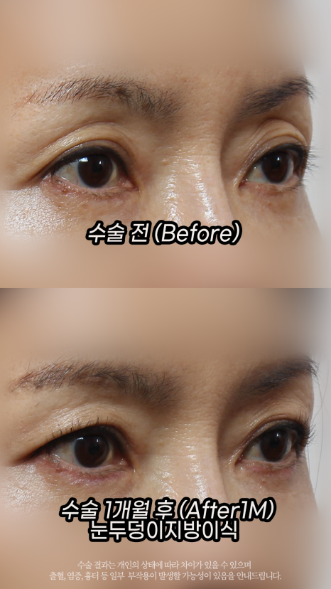 A Story About the Longevity of Eyelid (Eye Hole) Fat Grafting by Grace Plastic Surgery image 4