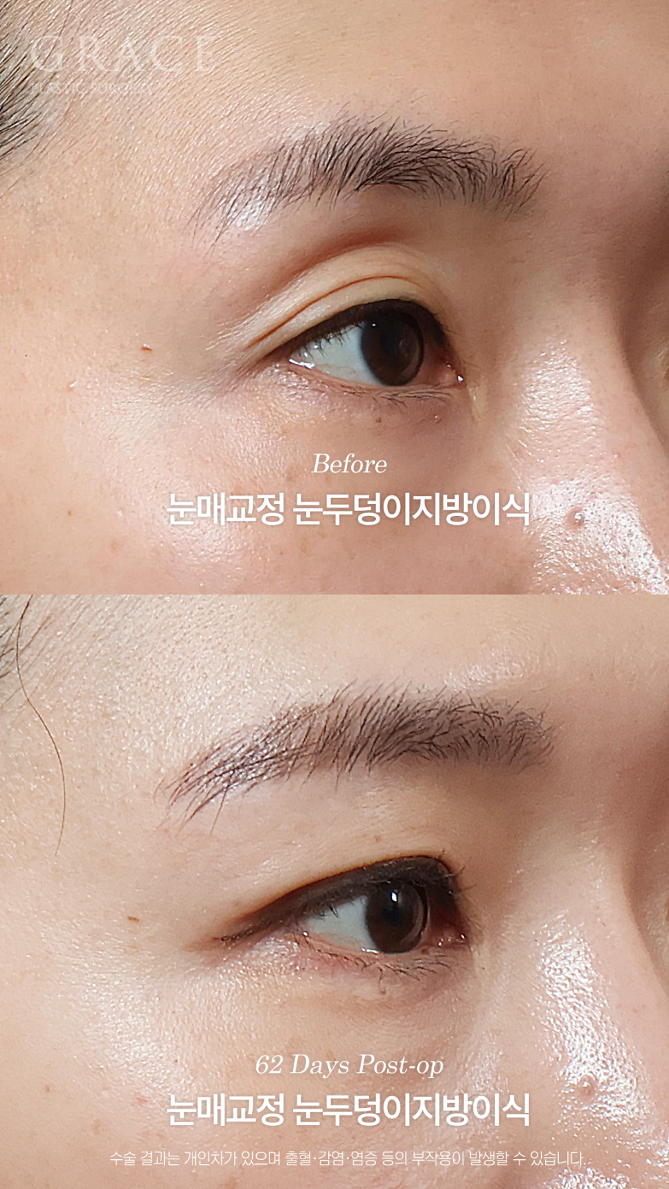 그레이스성형외과 눈두덩이 지방이식 1차로 끝내지 않은 진짜 이유 관련 이미지 4