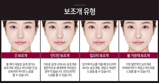 그레이스성형외과 보조개성형으로 이미지 변신 확실하게! 관련 이미지 3