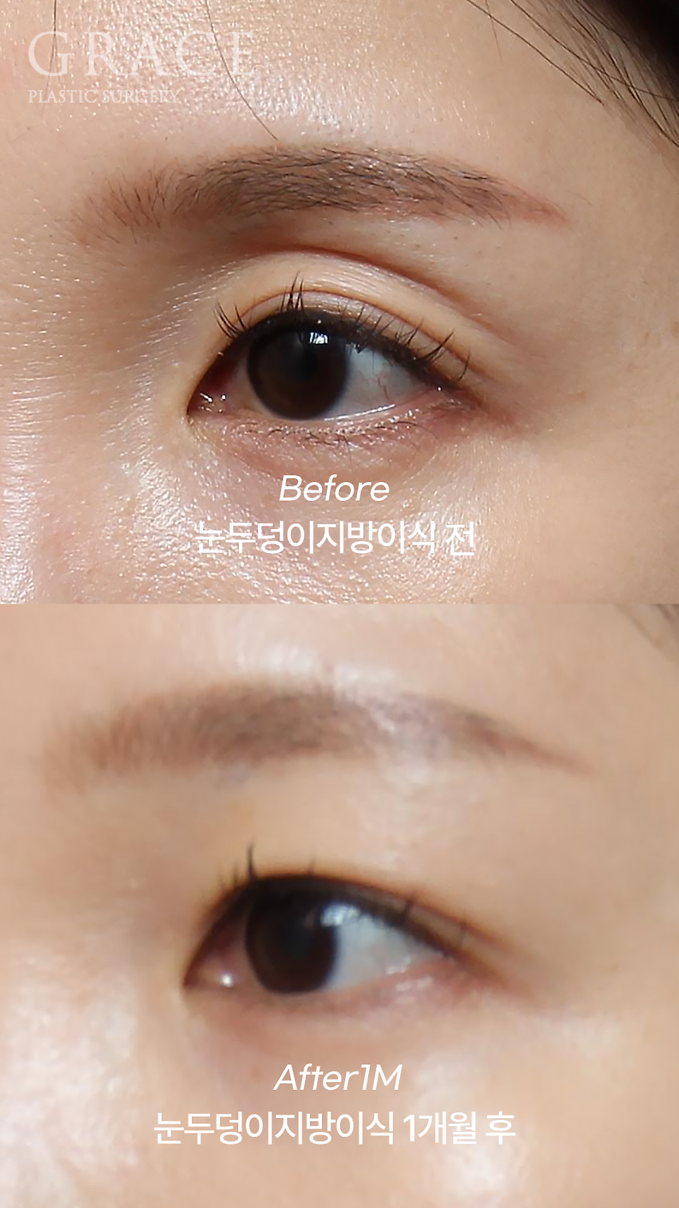 눈두덩이 지방이식 잘하는 병원? 의사 손에서 시작된다. 관련 이미지 2