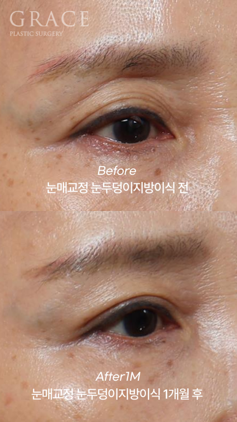 Is Upper Blepharoplasty Necessary at 58? Swelling Side Effects After Non-Incisional Ptosis Correction and Upper Eyelid Fat Grafting image 8