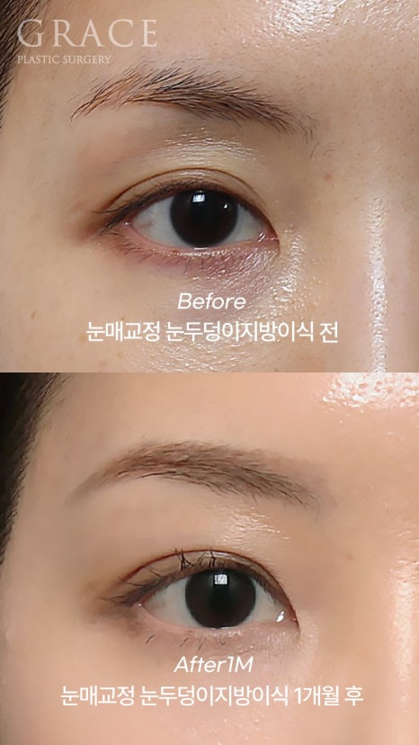 Eyebrow Hollow Fat Grafting Before and After Comparison – Gently Filling Sunken Eyes image 22