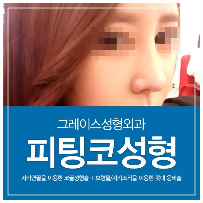 코성형잘하는 그레이스성형외과의 피팅코성형 관련 이미지 3