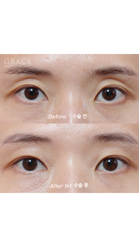 50대 눈꺼풀 지방이식 잘하는곳 염려되는 부작용 걱정까지 관련 이미지 8