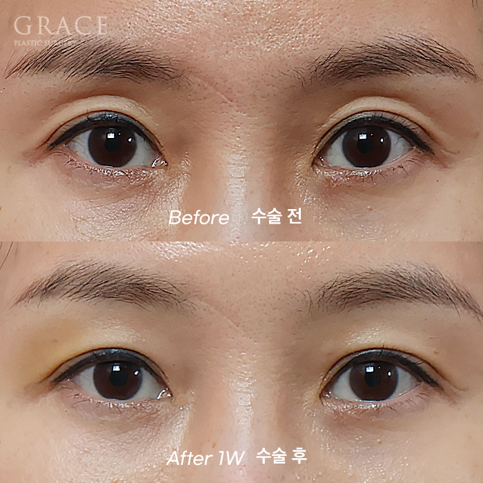 One-Week Changes After Eyelid Fat Grafting: Sunken Eye Hollows Regain Volume image 1