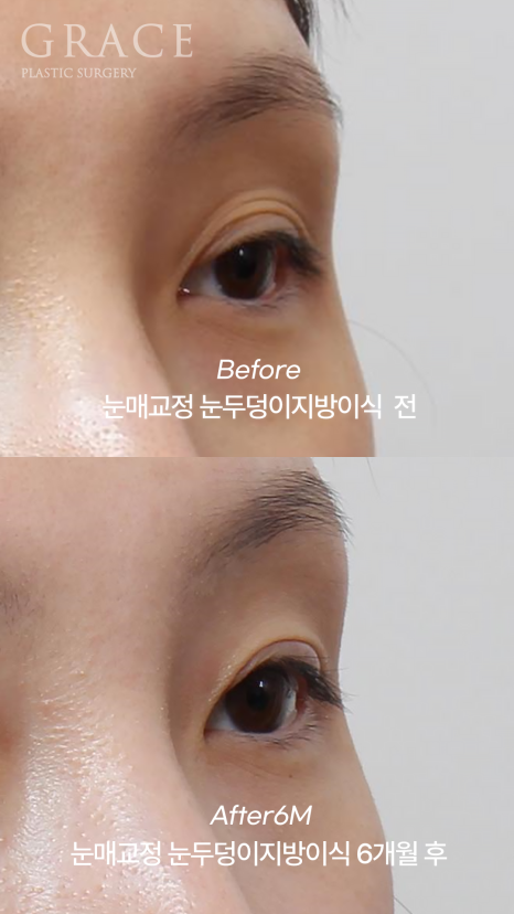 30대 눈꺼풀 지방이식 재꺼짐? 부작용? 6개월 후 관련 이미지 2