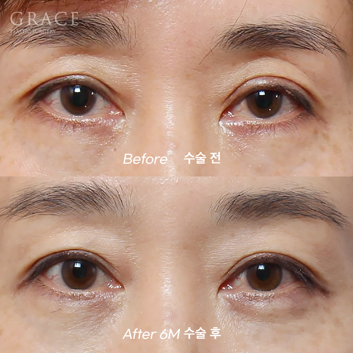 Upper Eyelid Fat Grafting Side Effects? The Difference in Survival Rates Between Frozen Fat and Fresh Fat image 10