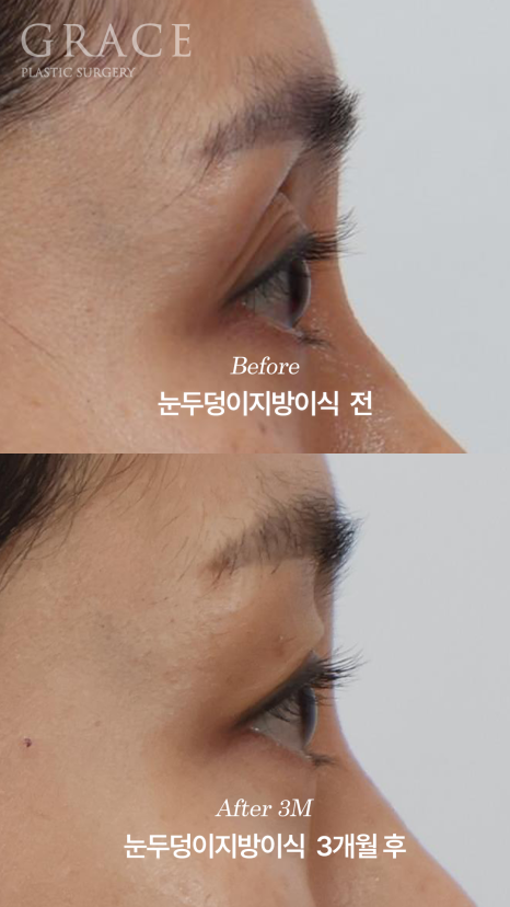 안와지방 주입 &middot; 눈두덩이지방이식 (1cc / 0.9cc) 관련 이미지 9