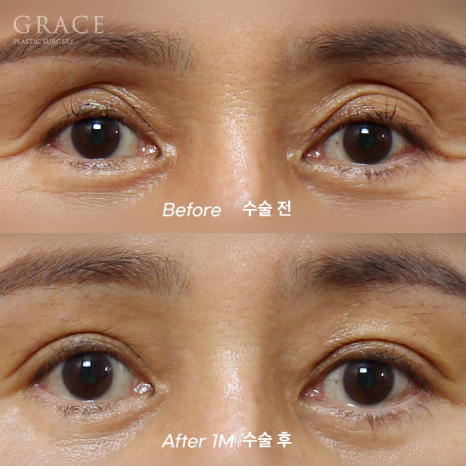 In Your 50s, Restoring a Youthful Look with Before-and-After Eye Surgery and Fat Grafting to the Upper Eyelids, Temples, Under-Eyes, and Above the Brows image 9