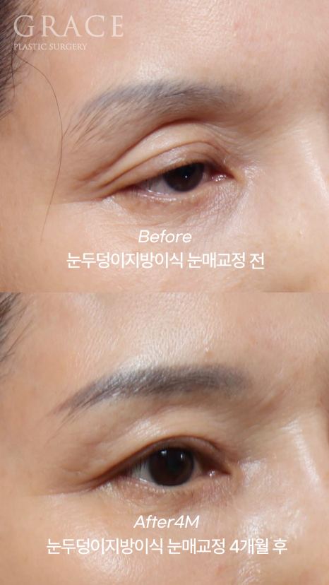 Upper Eyelid Fat Grafting Before and After in a Person in Their Late 50s and a Person in Their Late 20s image 3