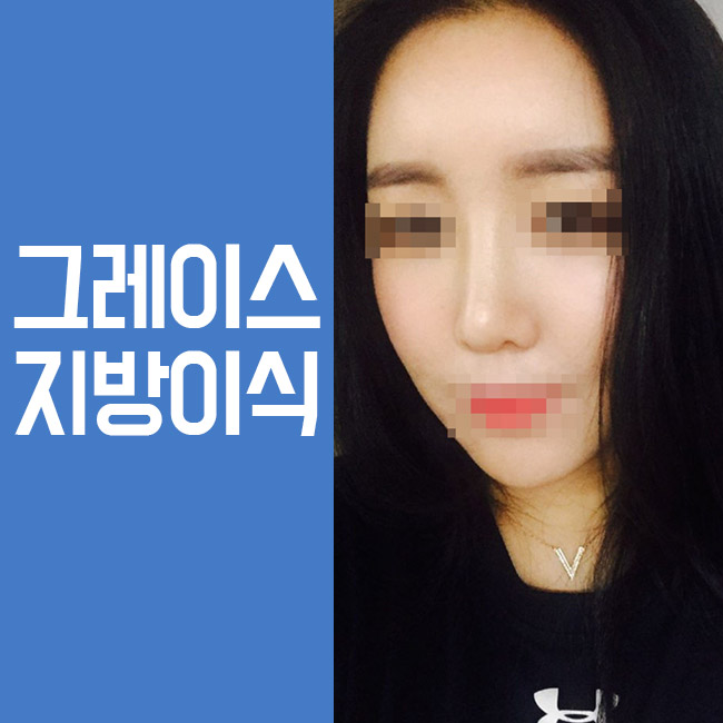 신사역 지방이식잘하는곳, 그레이스성형외과 PRP지방이식 관련 이미지 2