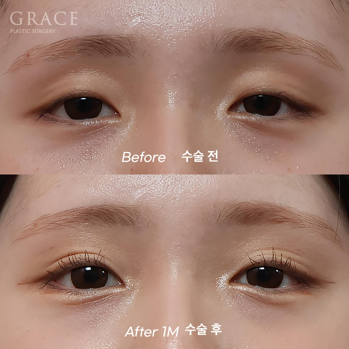 In Your Mid-20s, If You Have Ptosis Before and After Upper Eyelid Fat Grafting, Is Eye Correction Essential? image 1