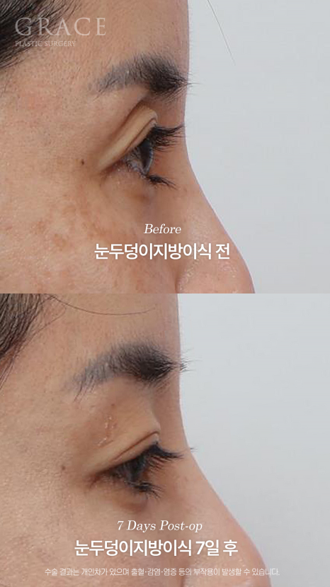 Will a Sunken Upper Eyelid Become Bumpy When You Close Your Eyes After Fat Grafting? image 13